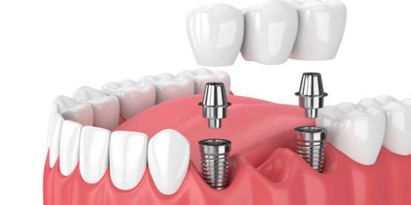 Prosthodontics