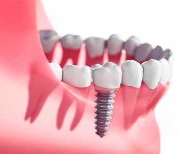 Implant Insertion