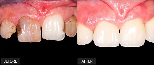 crown_bridge_veneer_logo 6