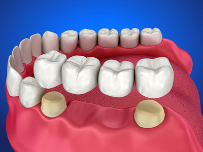 crowns-bridges 1