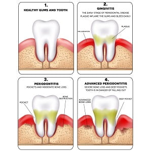 gum-disease 3