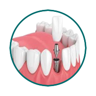 implant 1