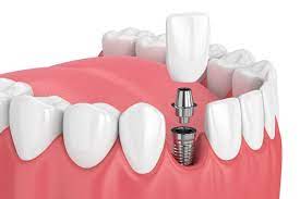 implant