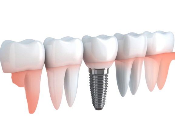 implant 1