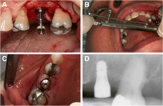 implant7