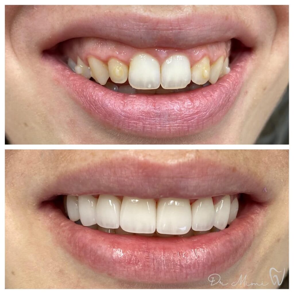 laser-gum-lift-and-contouring-gummy-2-1024×1024 5