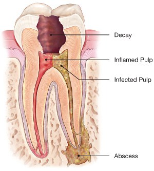 root canel 1